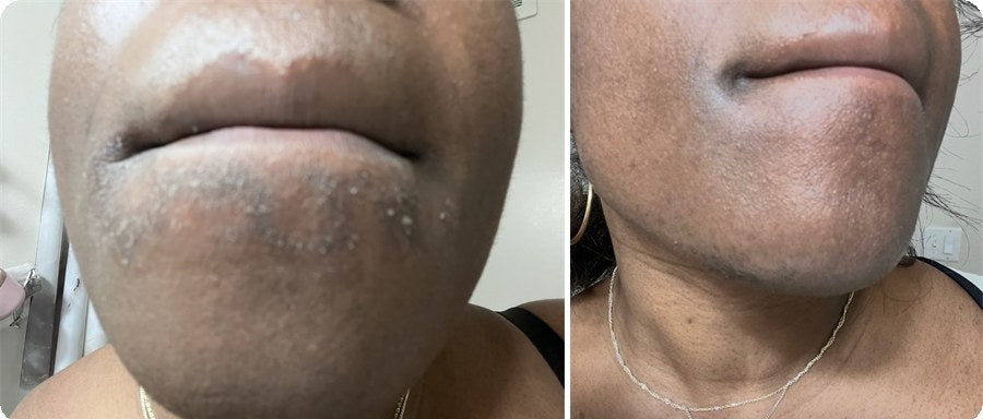 The founder's wife's chin with a rough, irritated patch from over-exfoliating before, and smooth skin after using OILTEA