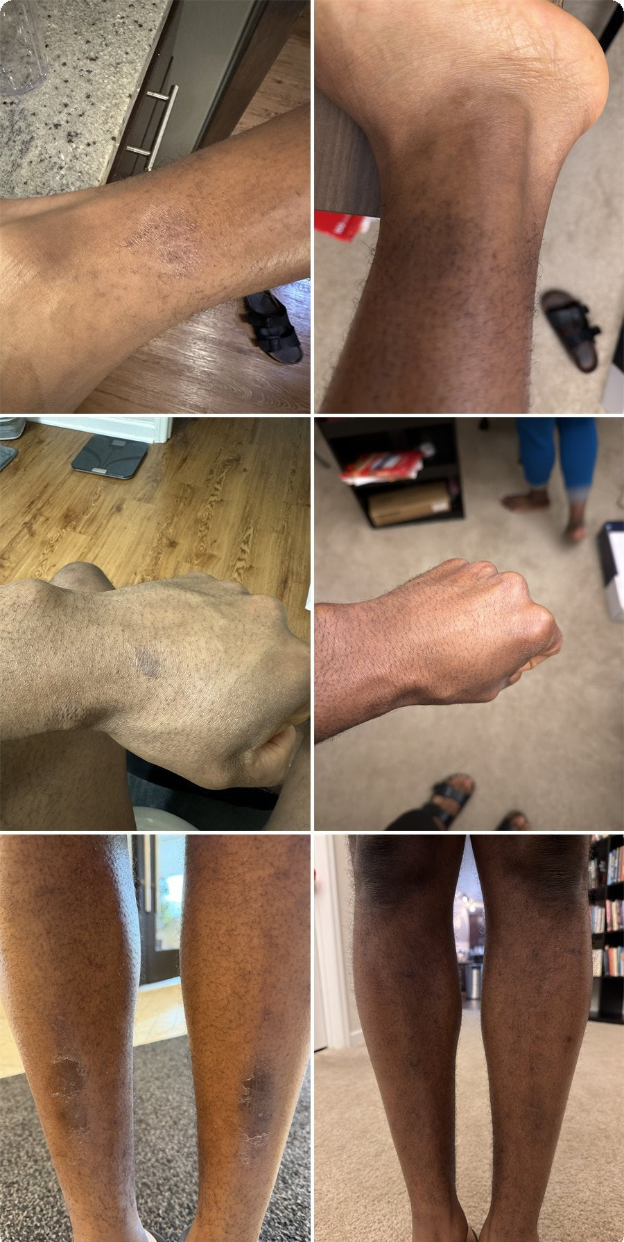 Collage of the founder's arm, ankle, hand and lower legs showing dry patches before, and clearer skin after using OILTEA